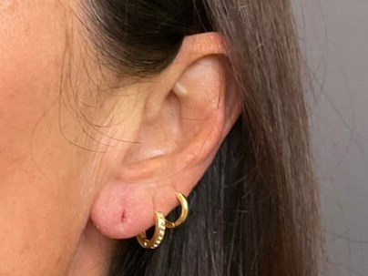 Earlobe Filler After