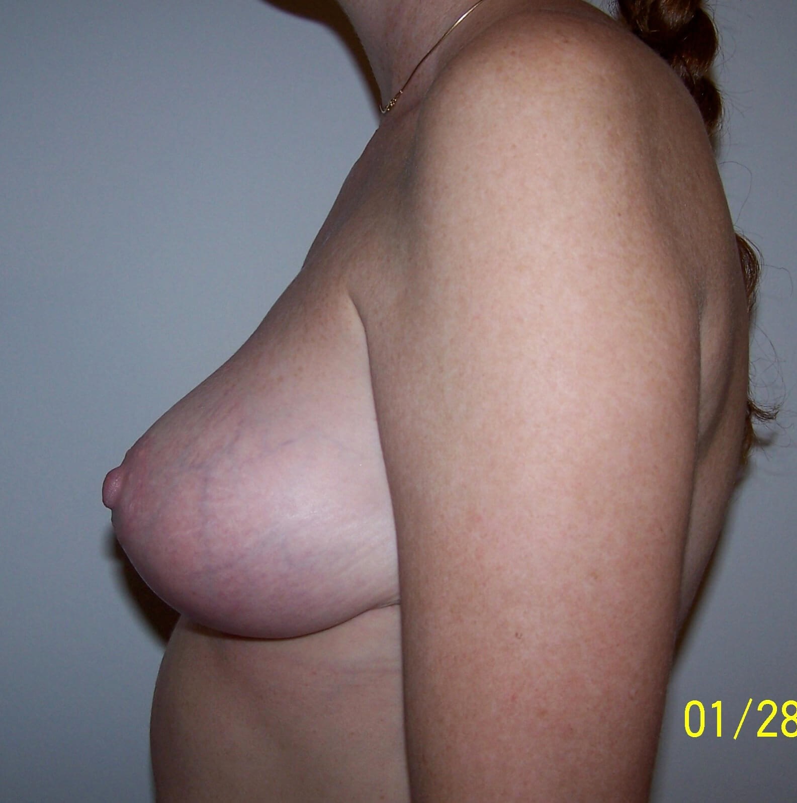 Breast Lift Side View After Breast Lift