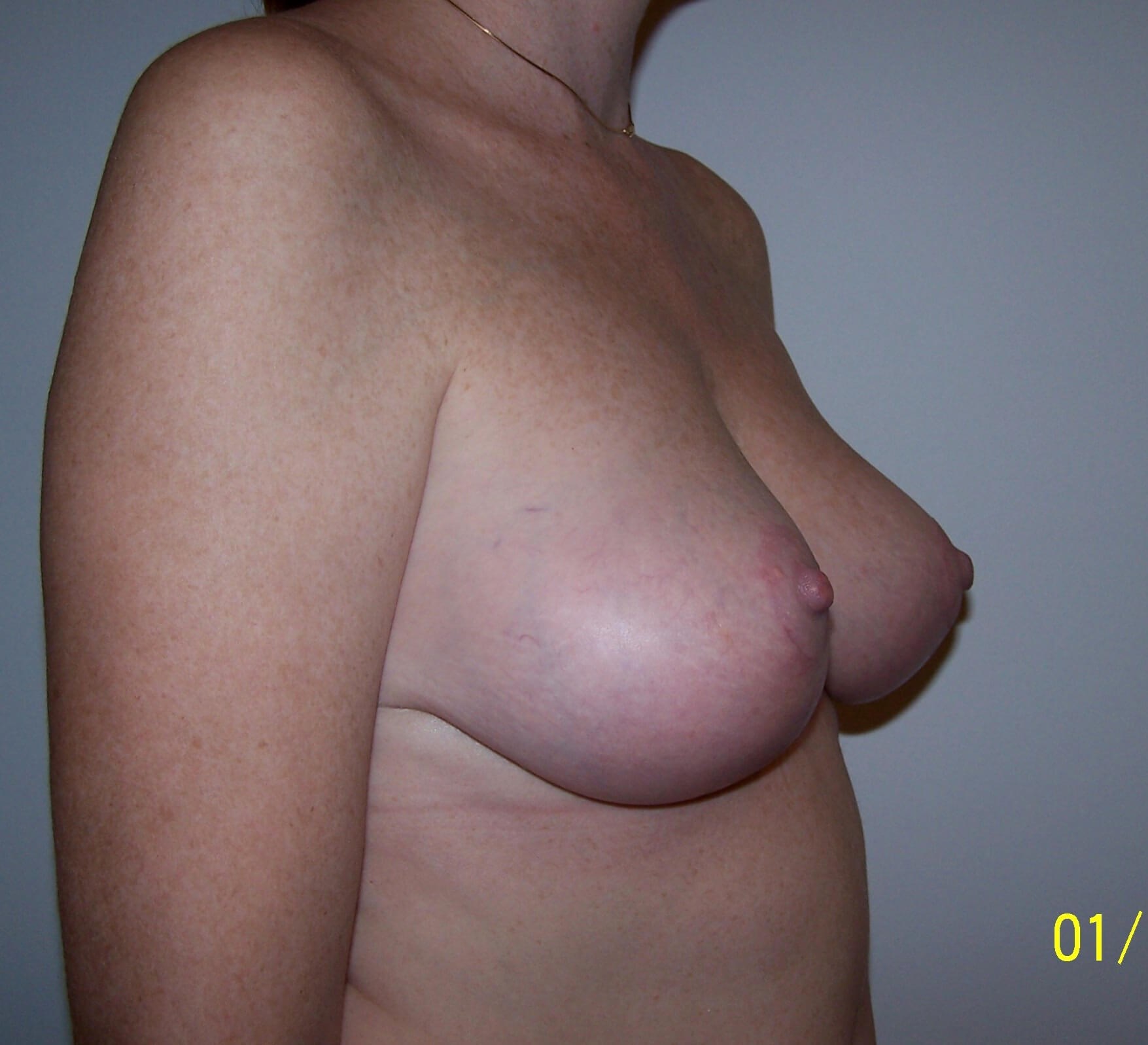 Breast Lift Oblique View After Breast Lift