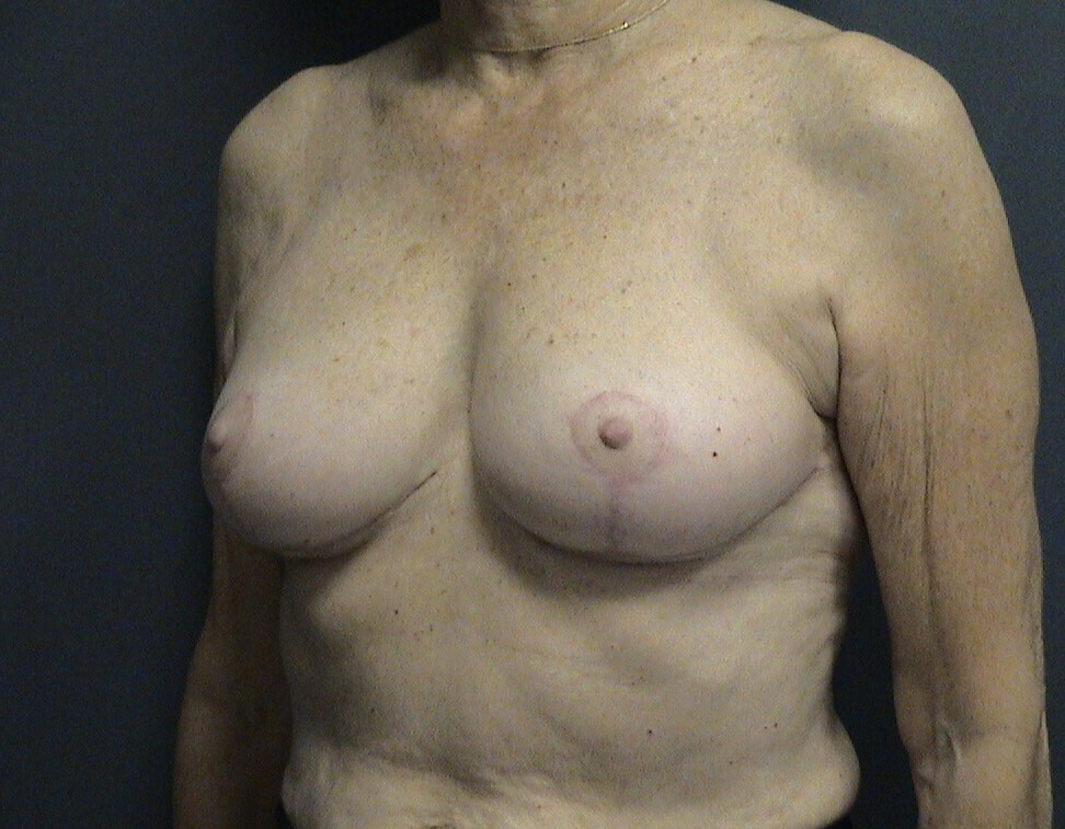 Breast Lift Oblique View After Breast Lift