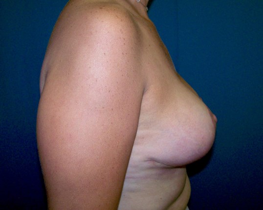 Breast Lift Side View After Breast Lift