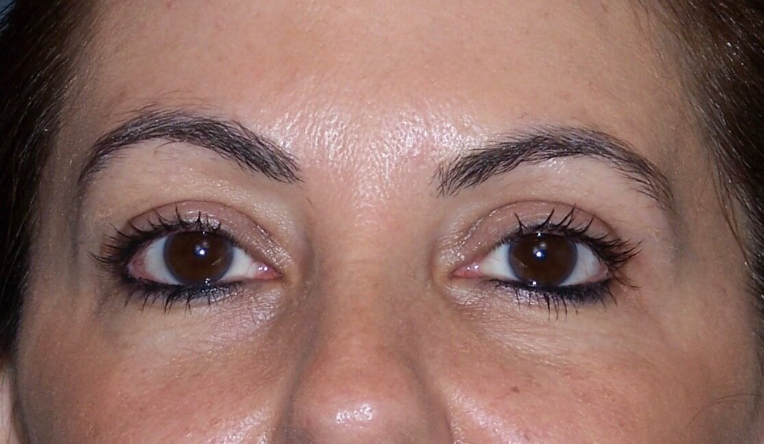 Upper Eyelid Lift Results After Upper Blepharoplasty
