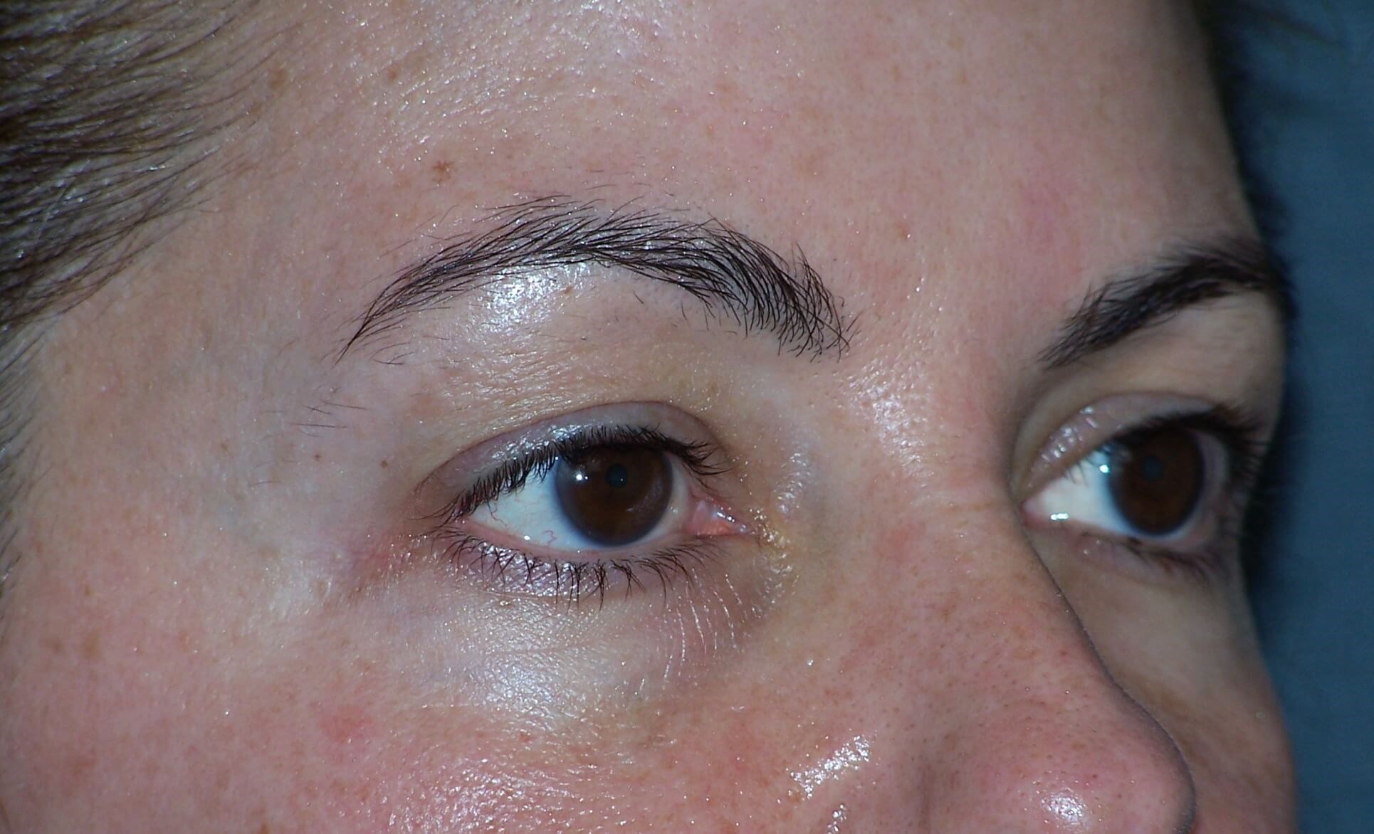Upper Eyelid Lift Results Before Upper Blepharoplasty