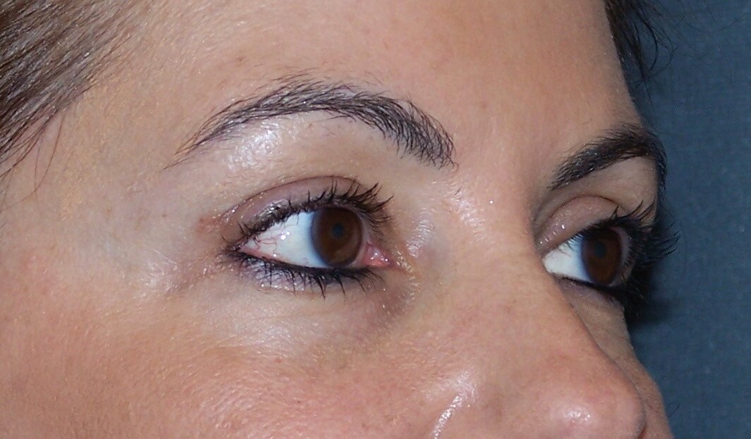 Upper Eyelid Lift Results After Upper Blepharoplasty