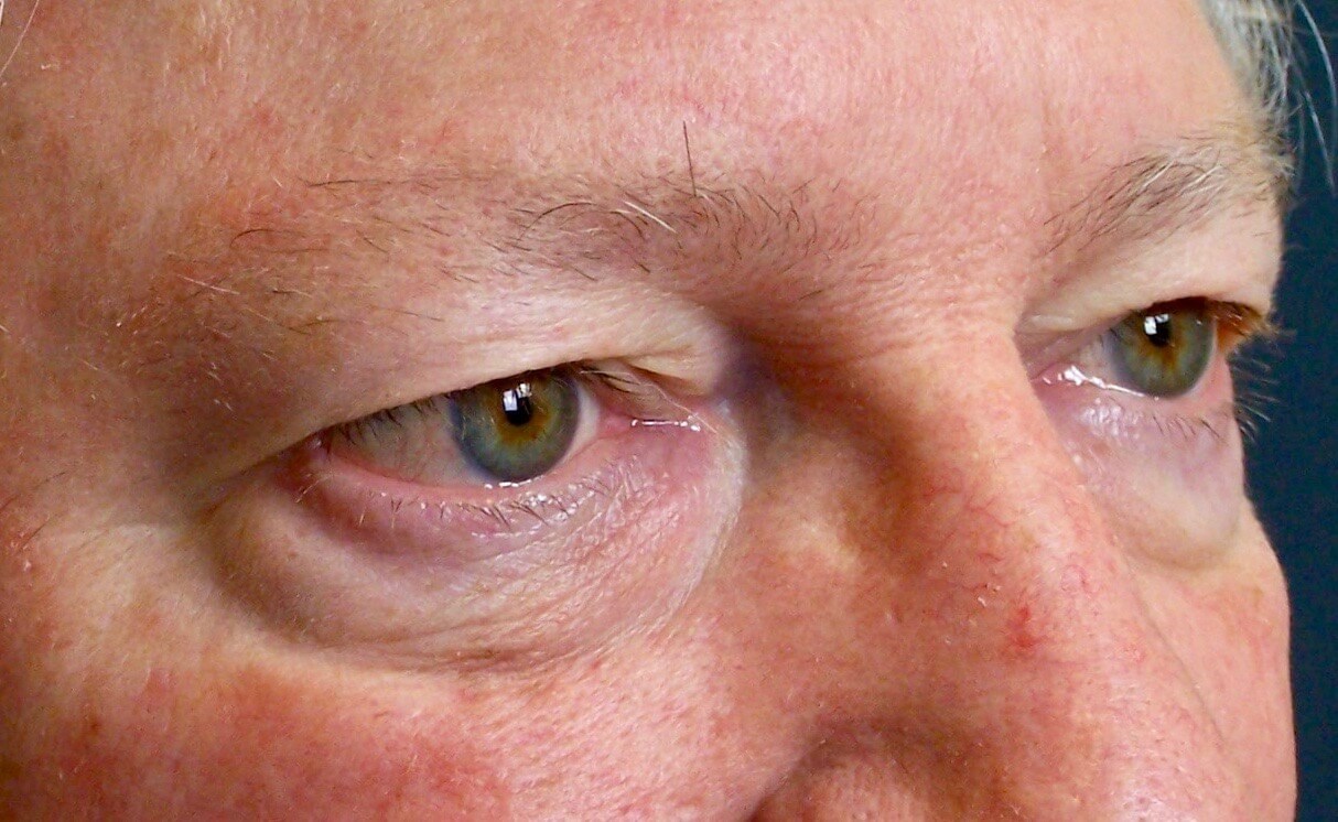 Upper & Lower Eyelid Lift Before Blepharoplasty