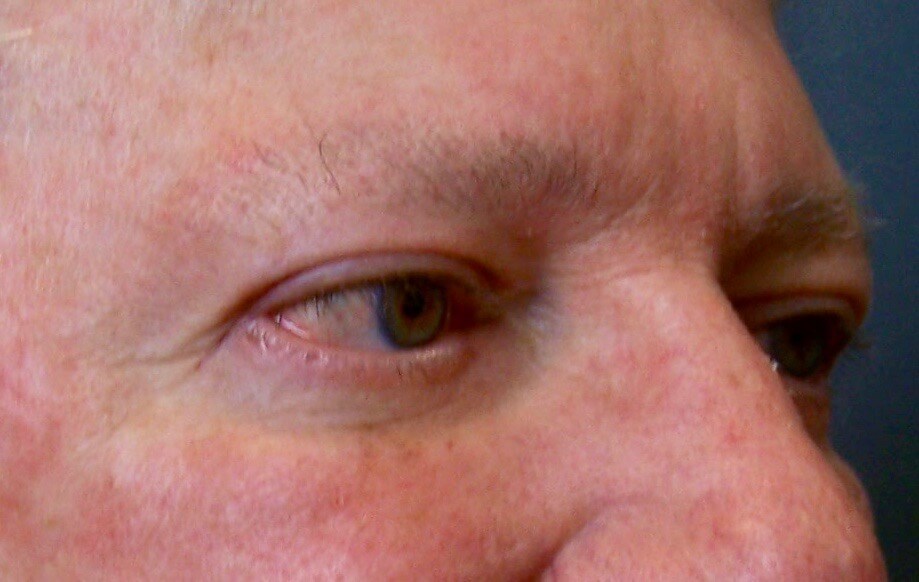 Upper & Lower Eyelid Lift After Blepharoplasty