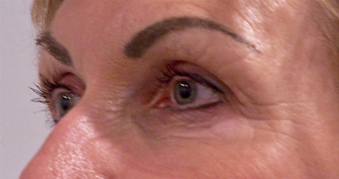 Upper Eyelid Lift Results After Blepharoplasty