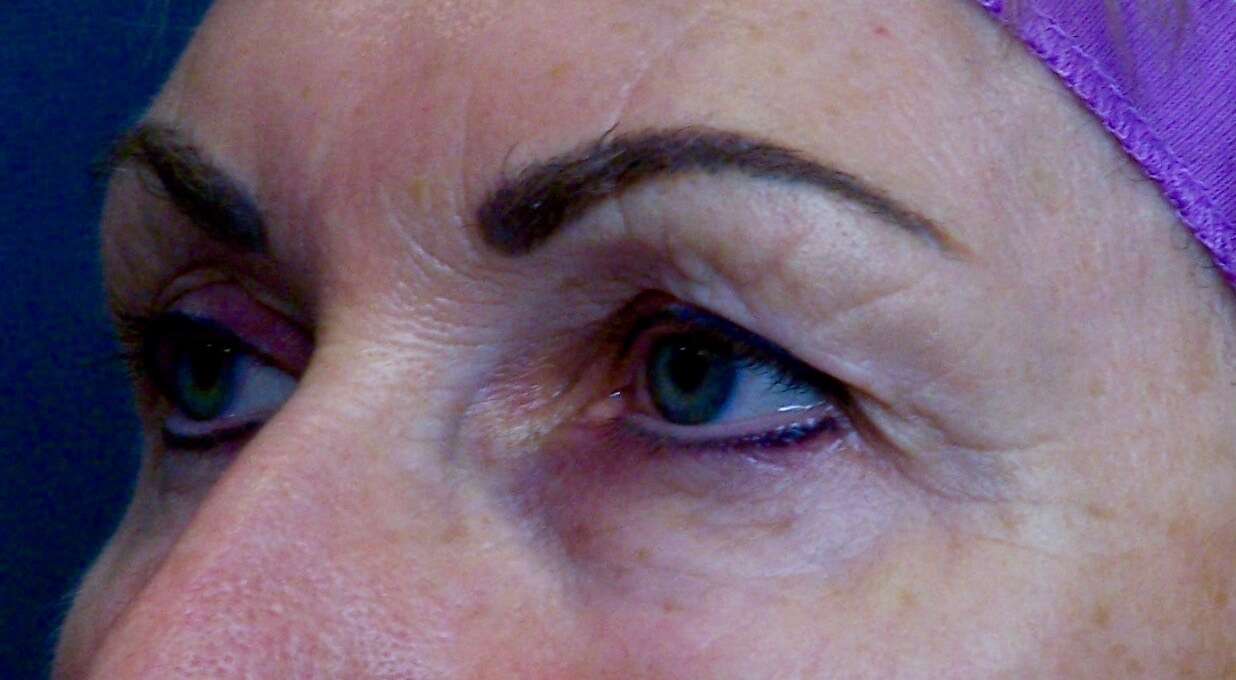 Upper Eyelid Lift Results Before Blepharoplasty