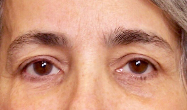 Upper Eyelid Lift Before Upper Blepharoplasty