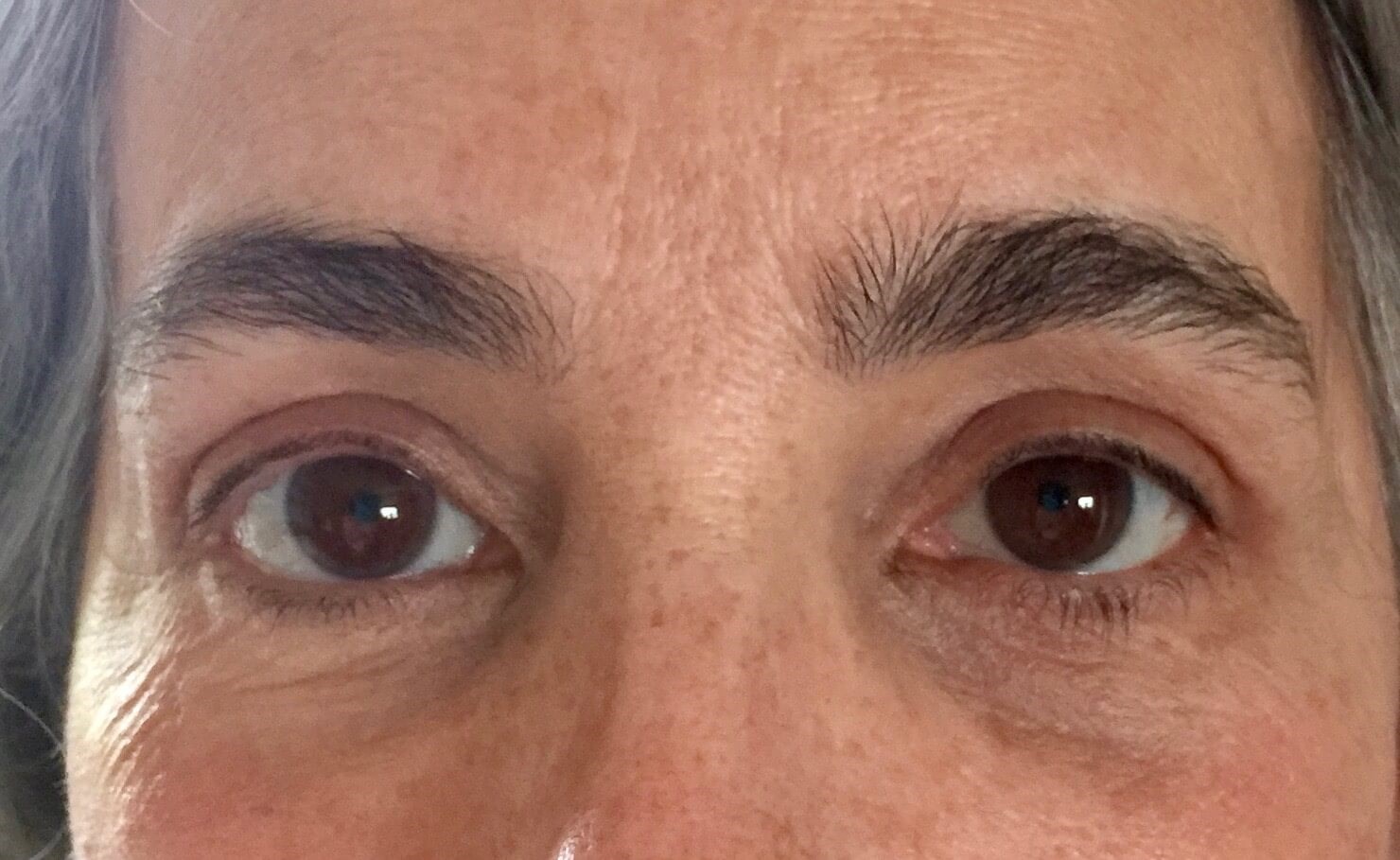 Upper Eyelid Lift After Upper Blepharoplasty