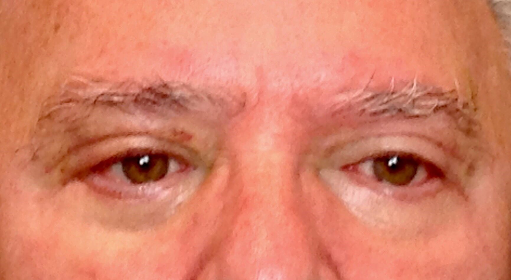 Upper & Lower Eyelid Lift After Blepharoplasty