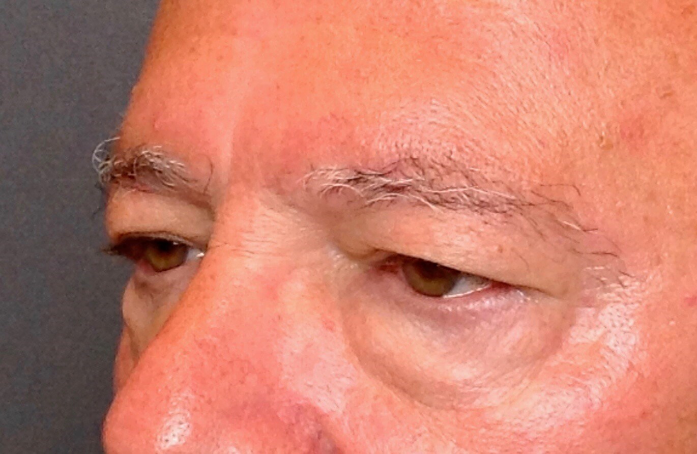 Upper & Lower Eyelid Lift Before Blepharoplasty