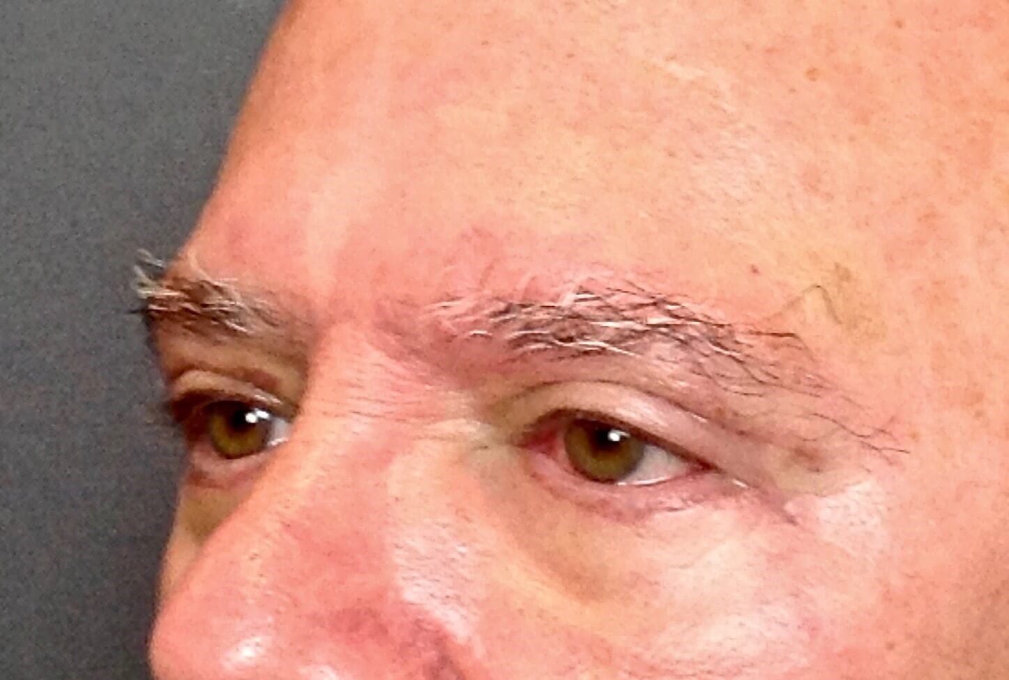 Upper & Lower Eyelid Lift After Blepharoplasty