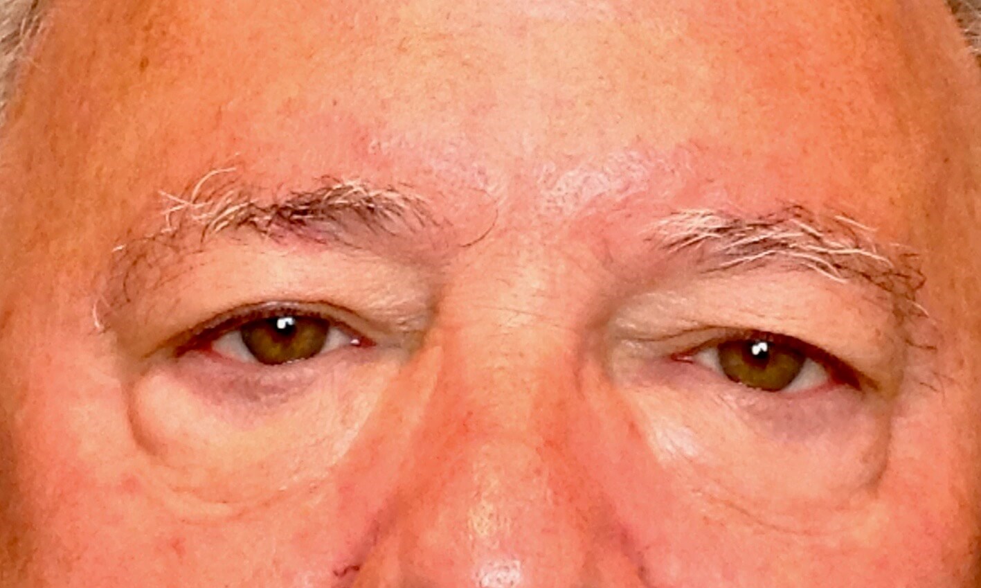 Upper & Lower Eyelid Lift Before Blepharoplasty