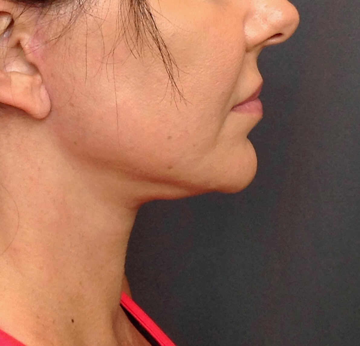 Face Lift After Face Lift