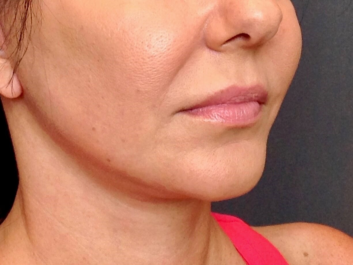 Face Lift After Face Lift
