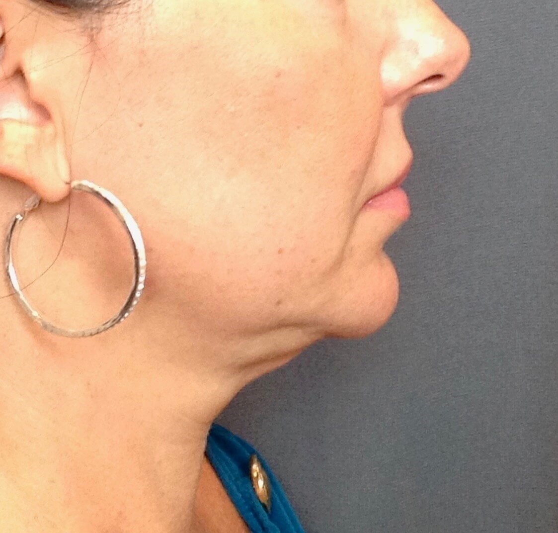 Face Lift Before Face Lift