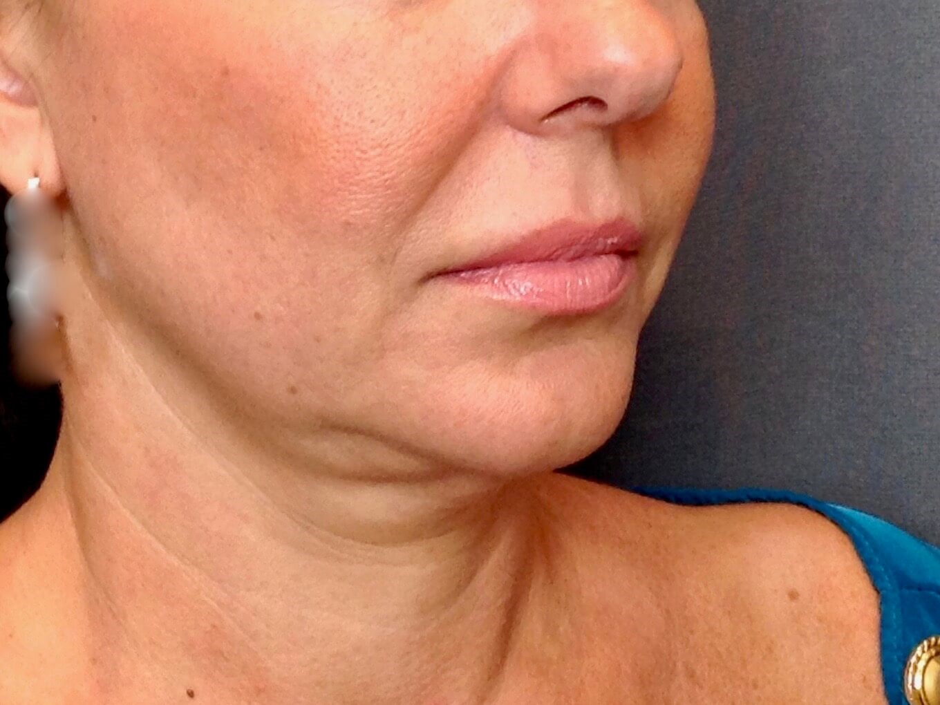 Face Lift Before Face Lift