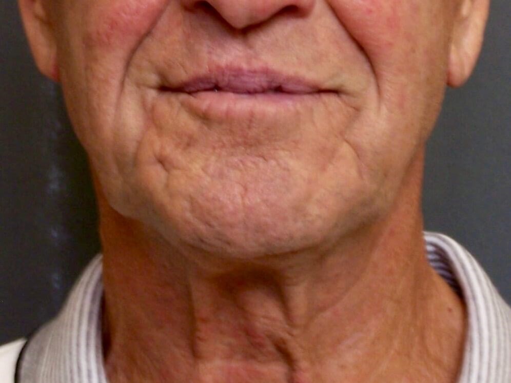 Face Lift Before Face Lift