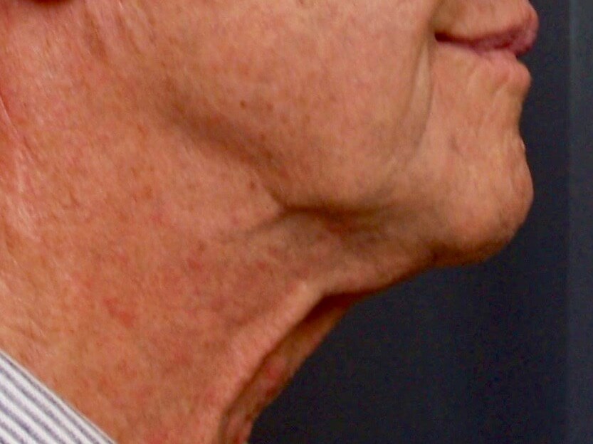Face Lift Before Face Lift