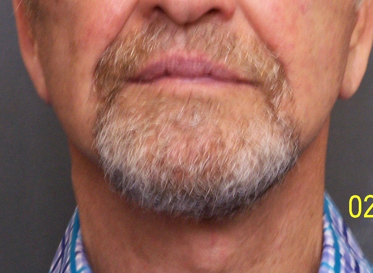 Face Lift After Face Lift