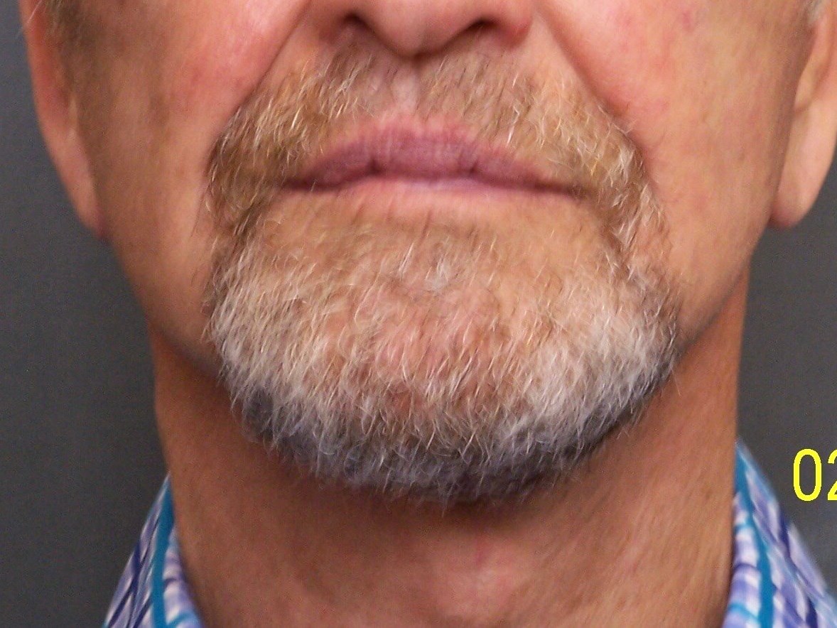 Face Lift After Face Lift