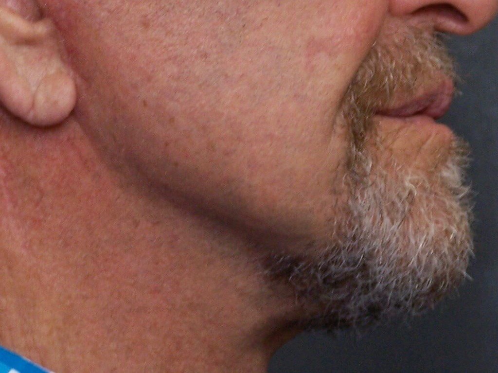 Face Lift After Face Lift
