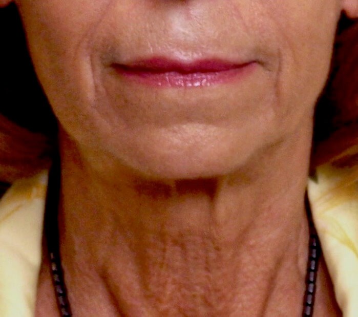 Face Lift Before Face Lift