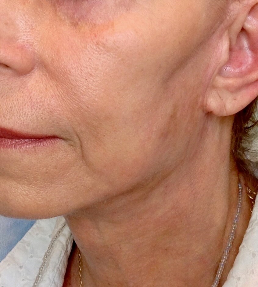Face Lift After Face Lift