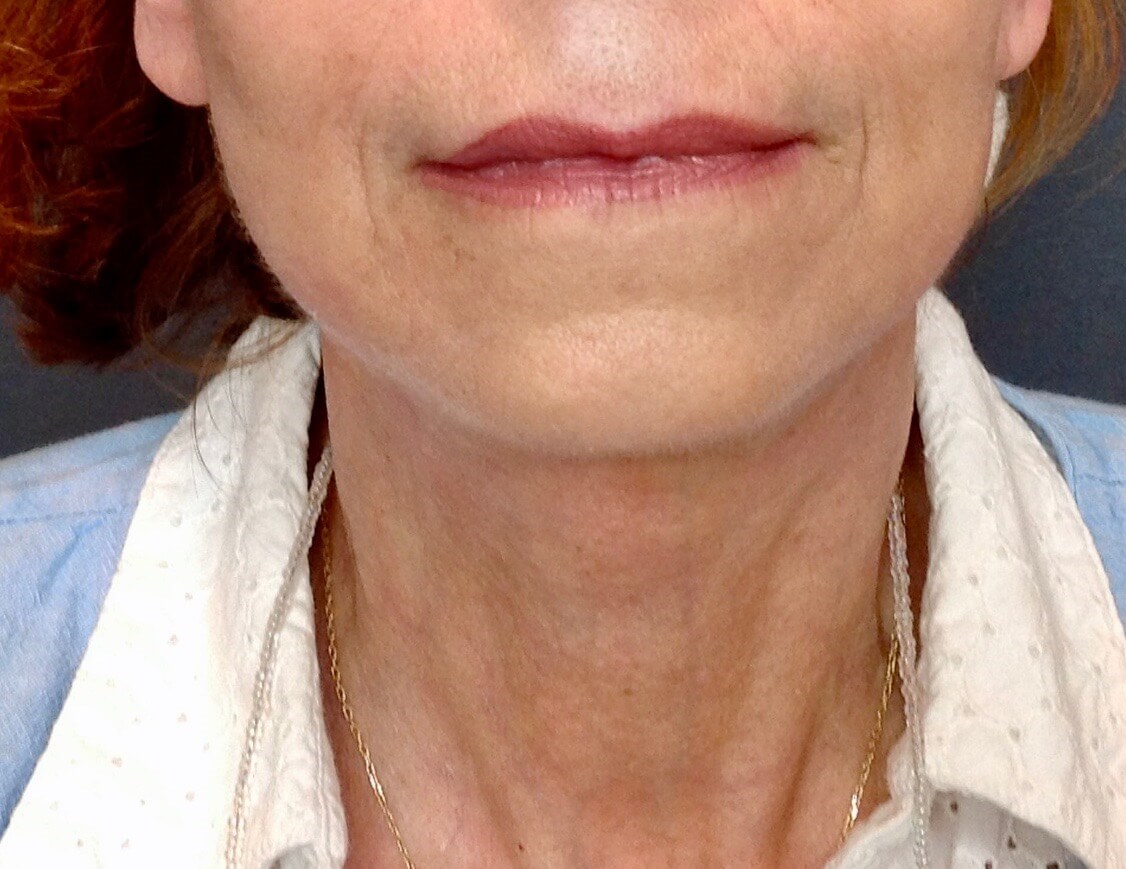 Face Lift After Face Lift