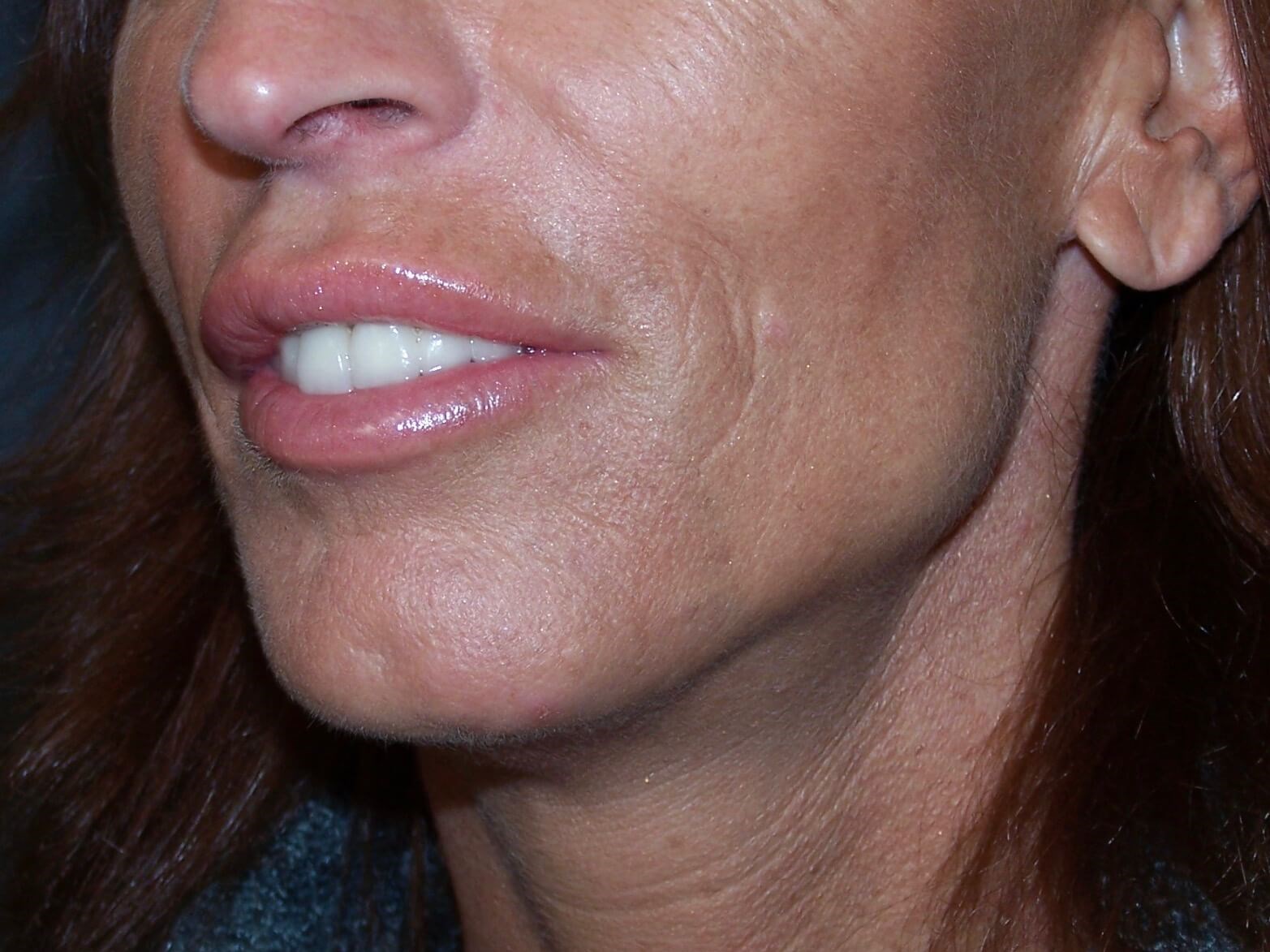 Face Lift After Face Lift