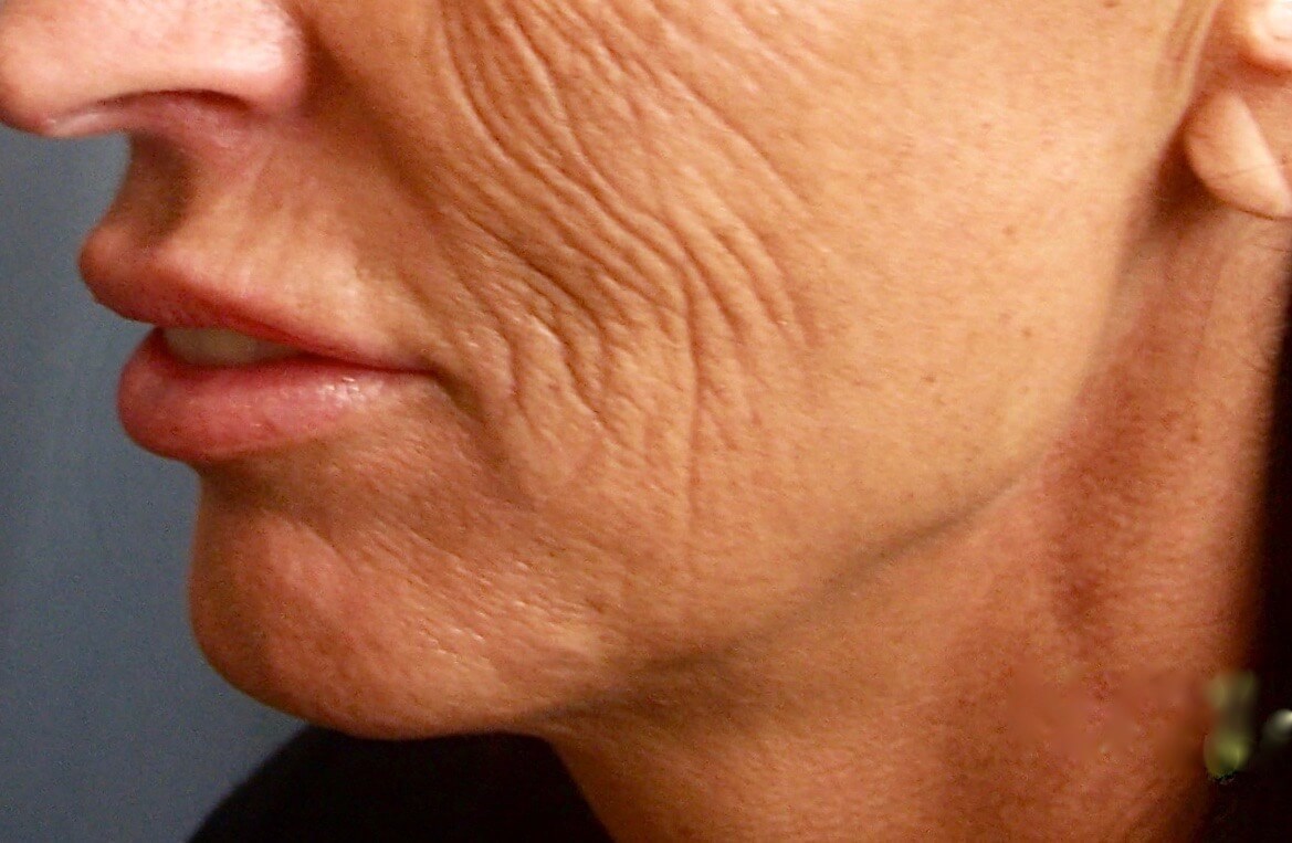 Face Lift Before Face Lift