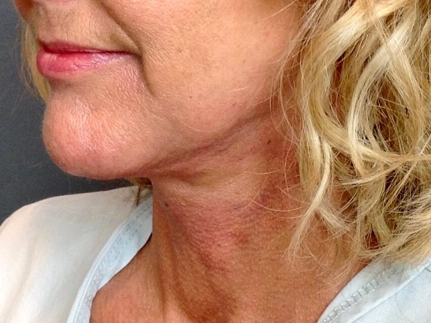 Neck Lift, Cervicoplasty After Neck Lift