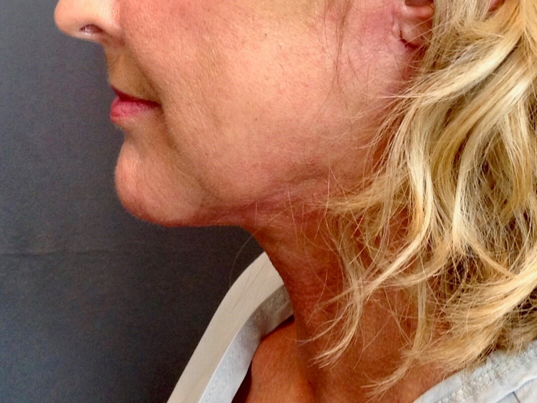 Neck Lift, Cervicoplasty After Neck Lift