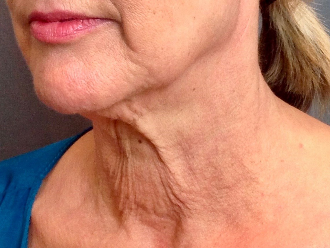 Neck Lift, Cervicoplasty Before Neck Lift