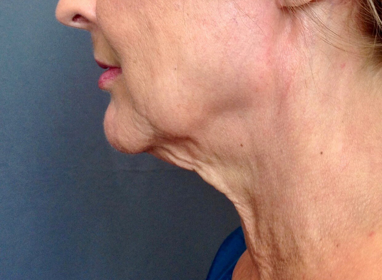Neck Lift, Cervicoplasty Before Neck Lift
