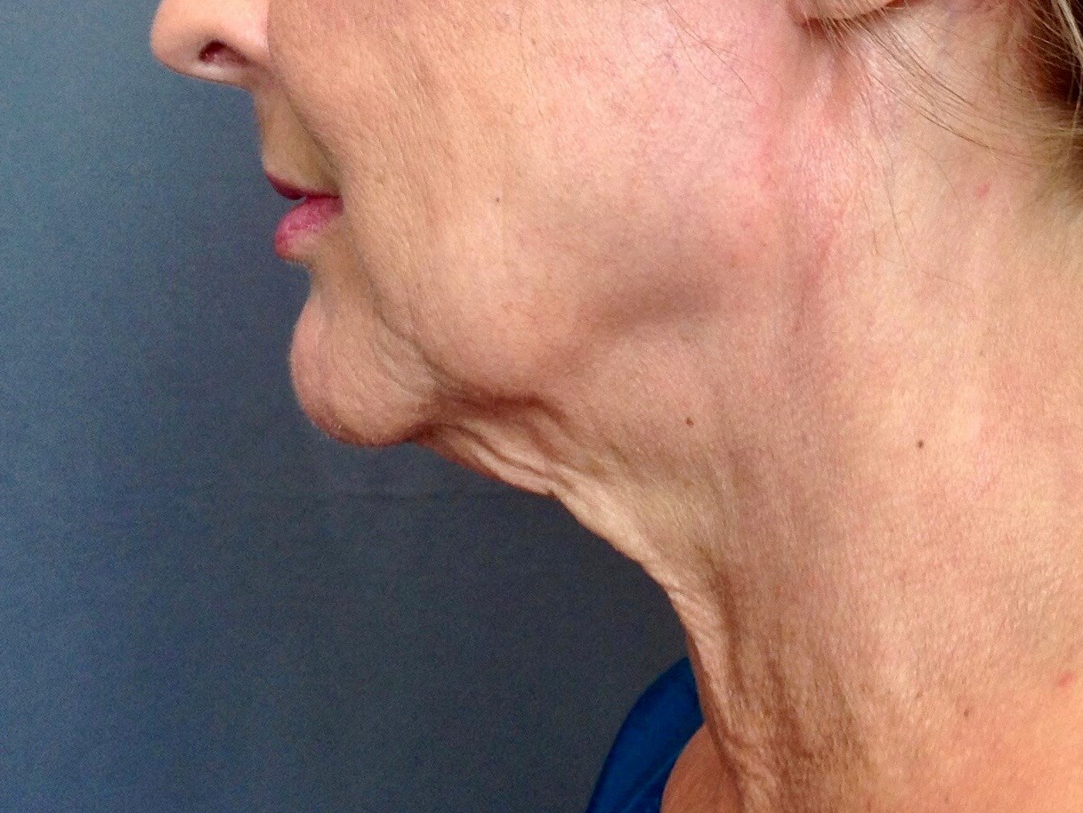 Neck Lift, Cervicoplasty Before Neck Lift