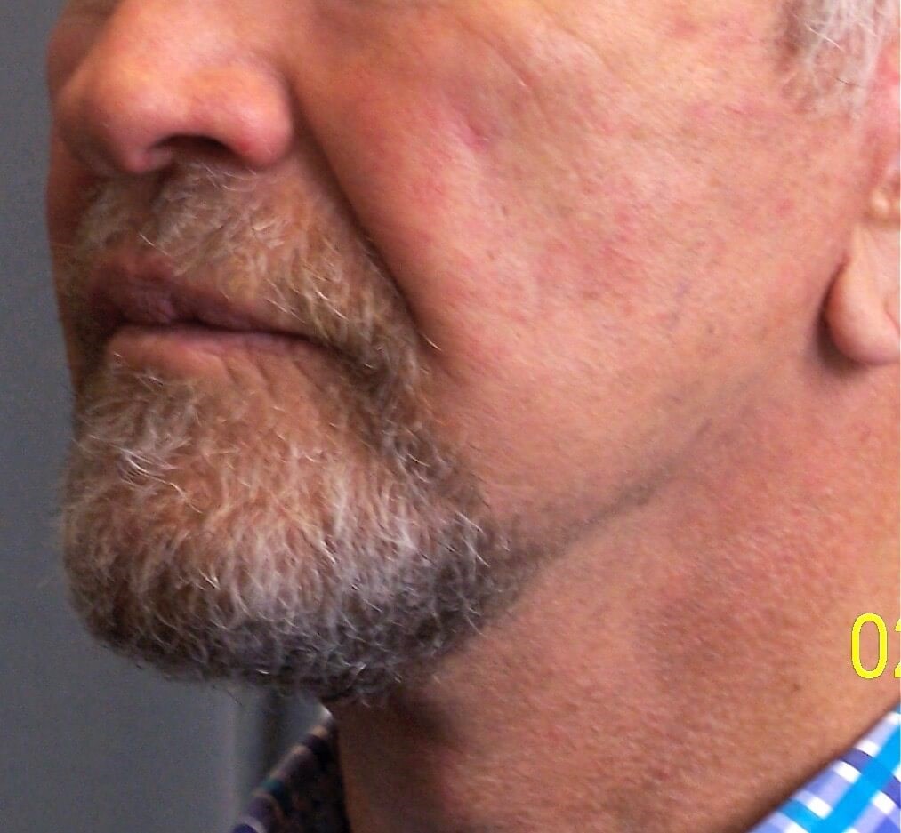 Neck Lift, Cervicoplasty After Neck Lift