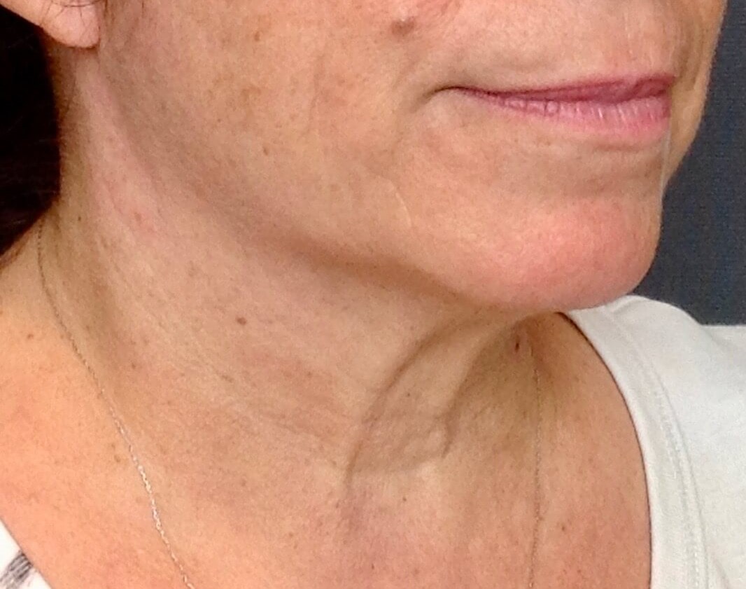 Neck Lift, Cervicoplasty Before Neck Lift