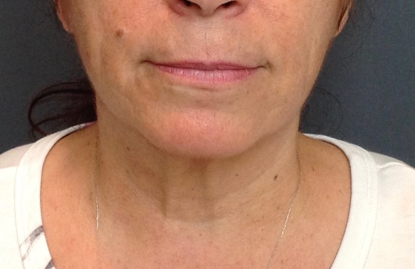 Neck Lift, Cervicoplasty Before Neck Lift