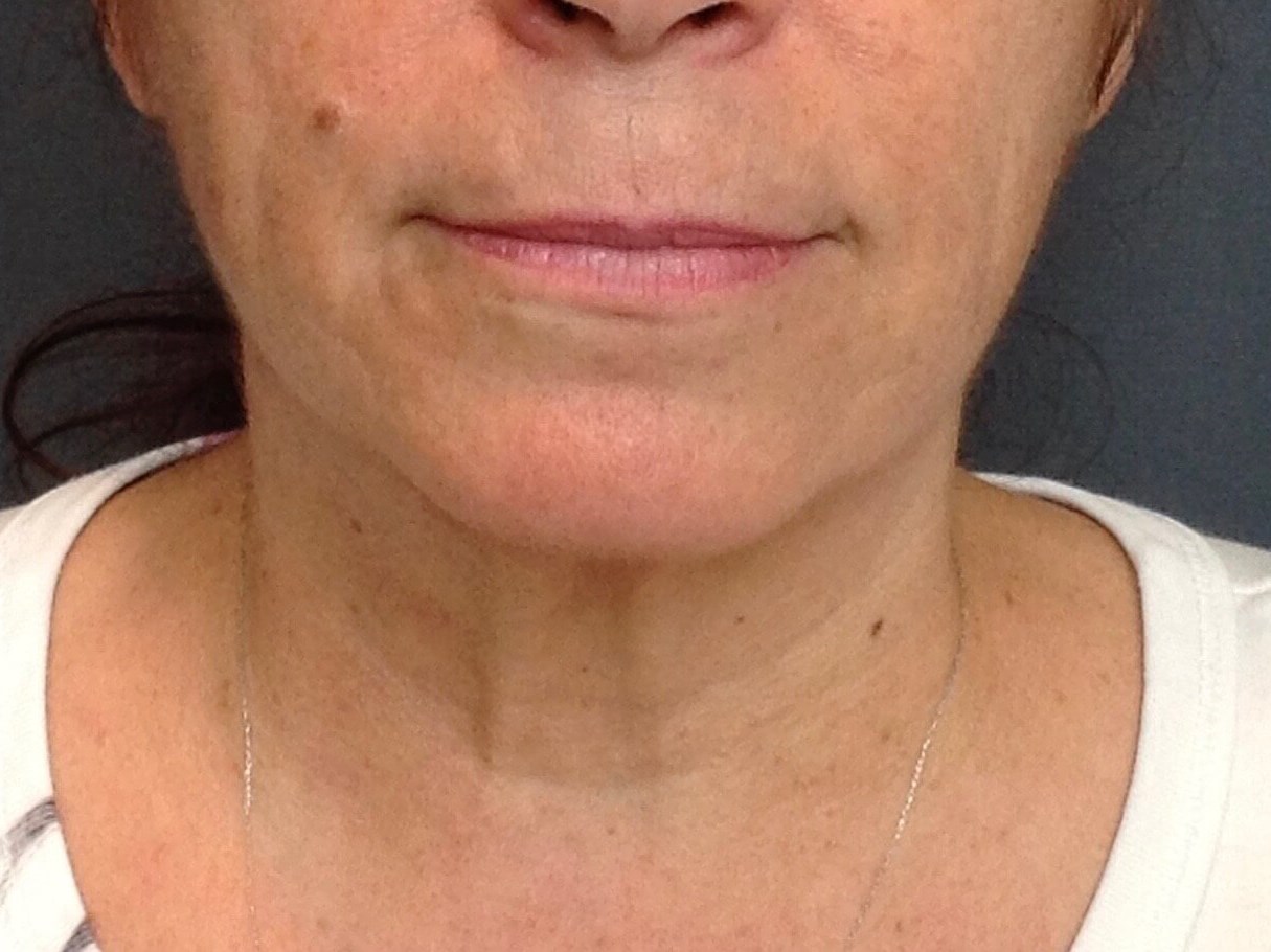 Neck Lift, Cervicoplasty Before Neck Lift