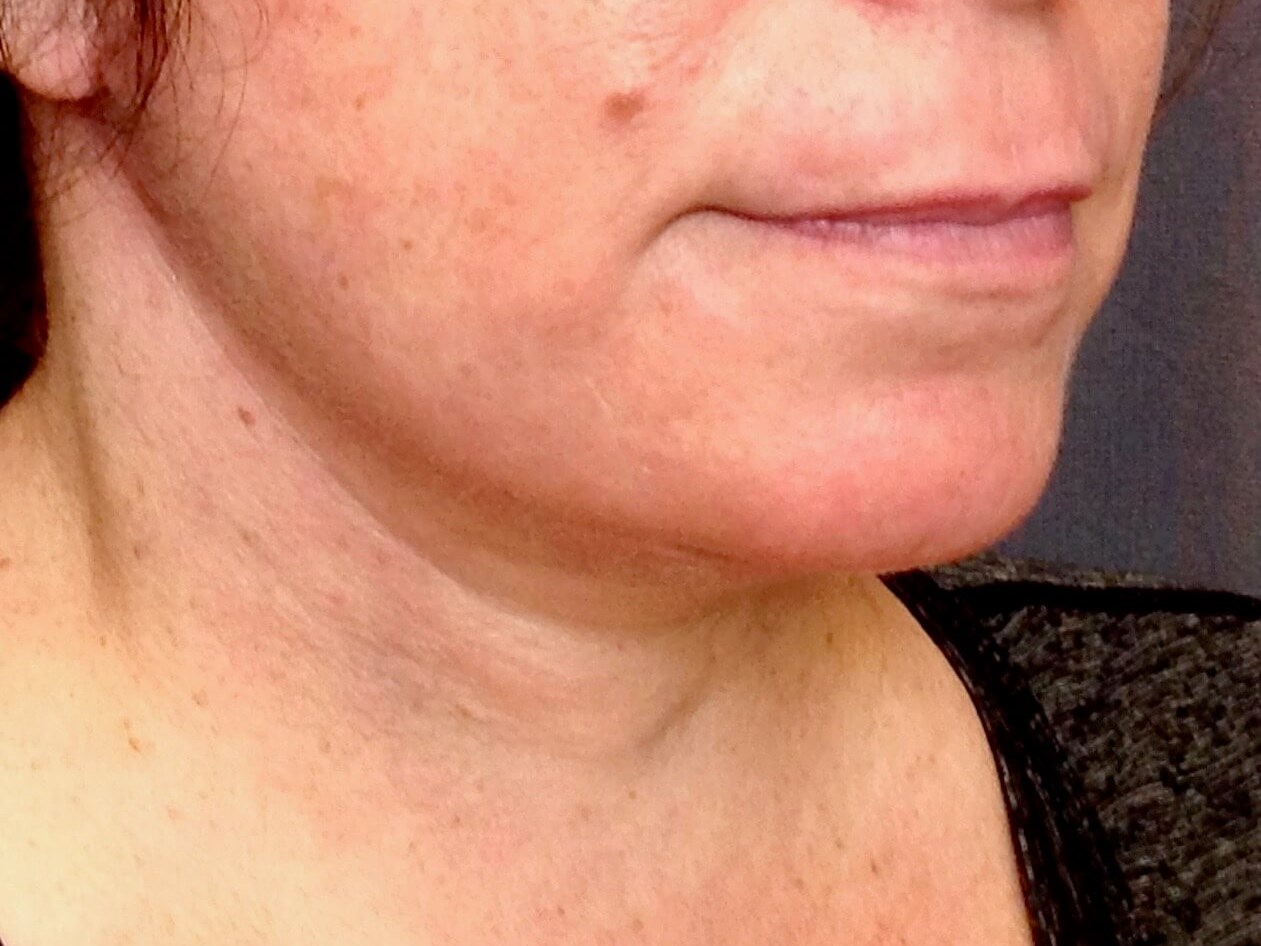 Neck Lift, Cervicoplasty After Neck Lift