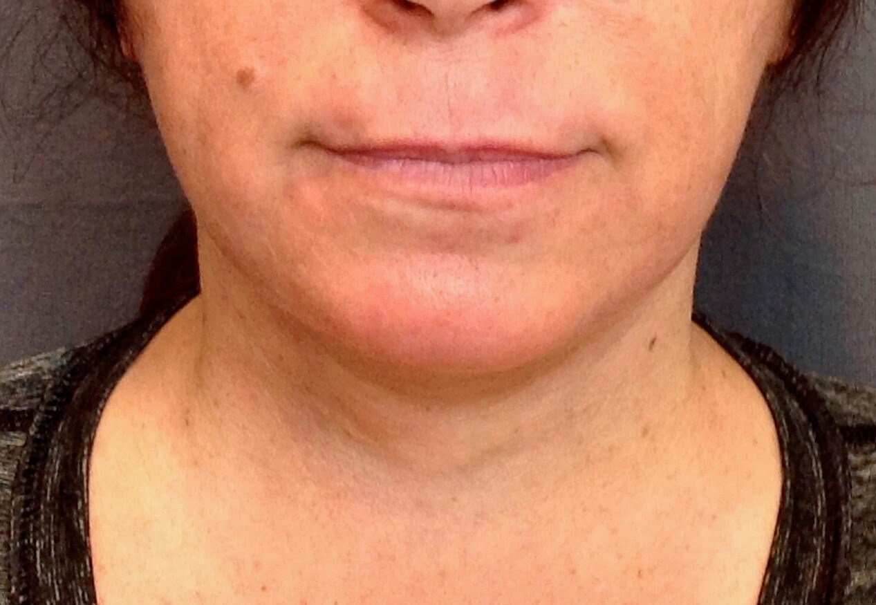 Neck Lift, Cervicoplasty After Neck Lift