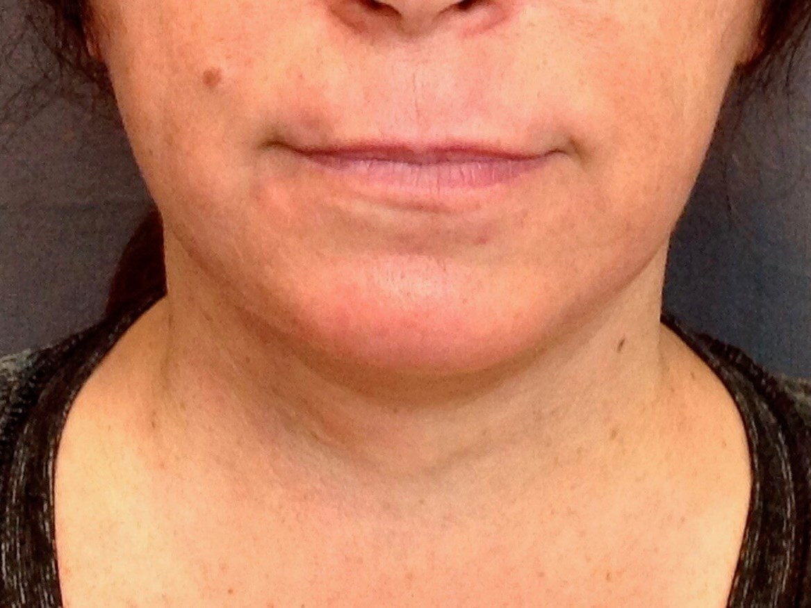 Neck Lift, Cervicoplasty After Neck Lift