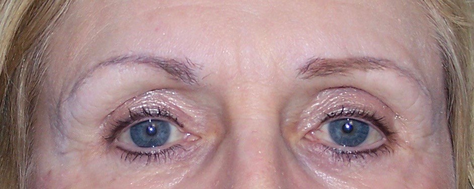 Brow Lift, Forehead Lift After Brow Lift