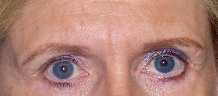 Brow Lift, Forehead Lift Before Brow Lift