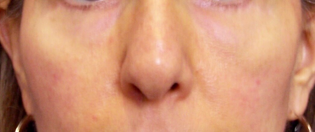 fat grafting to face After face fat transfer