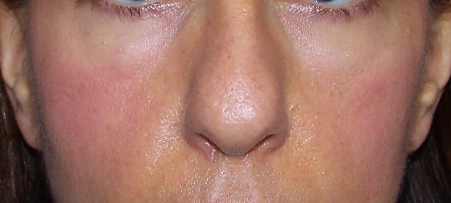 fat grafting to face Before face fat transfer