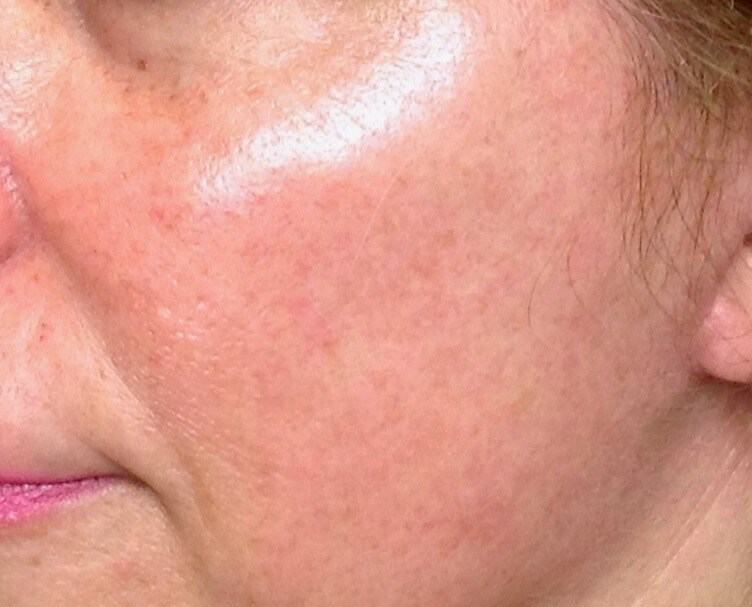 First Face Procedure After First Face