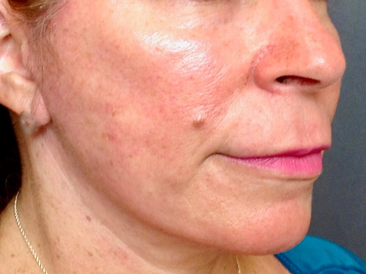 First Face Procedure After First Face